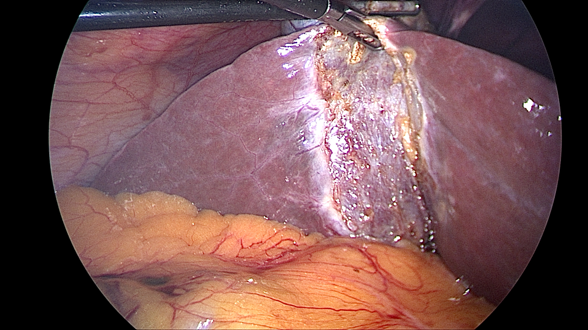 Cystic plate after gallbladder removal